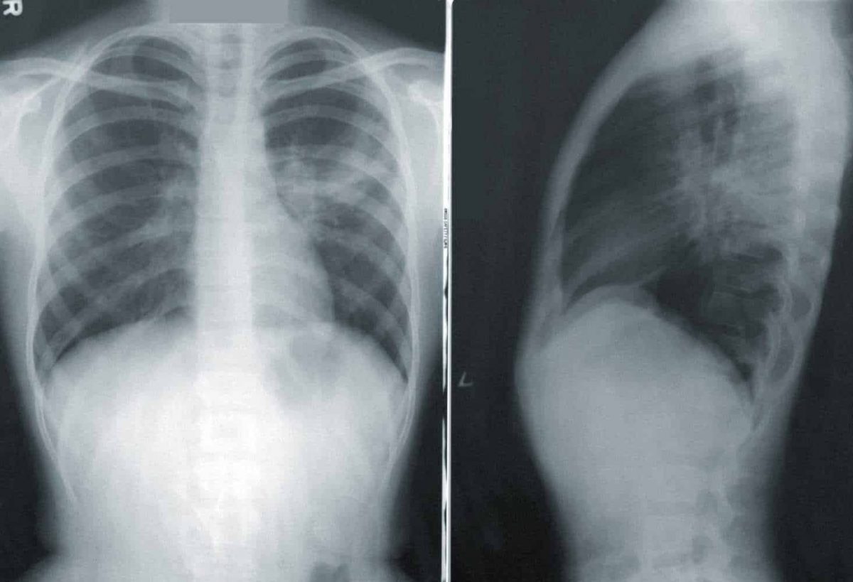 Pulmones de un paciente afectado por coronavirus.