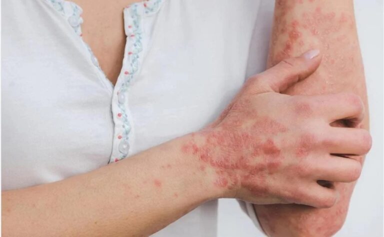 La  viruela del mono puede ser mortal para personas con VIH, según estudio